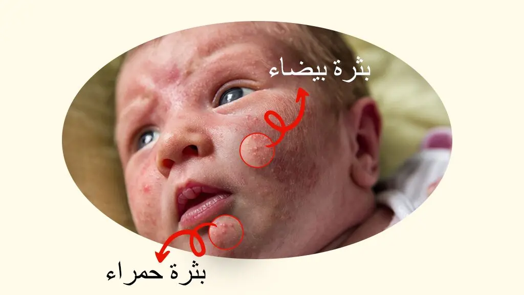 أعراض حب الشباب الوليدي