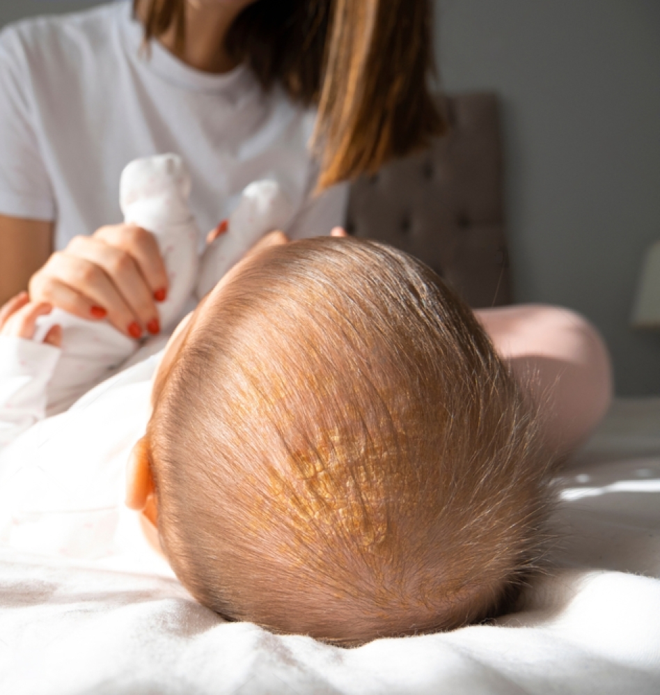Cradle Cap
