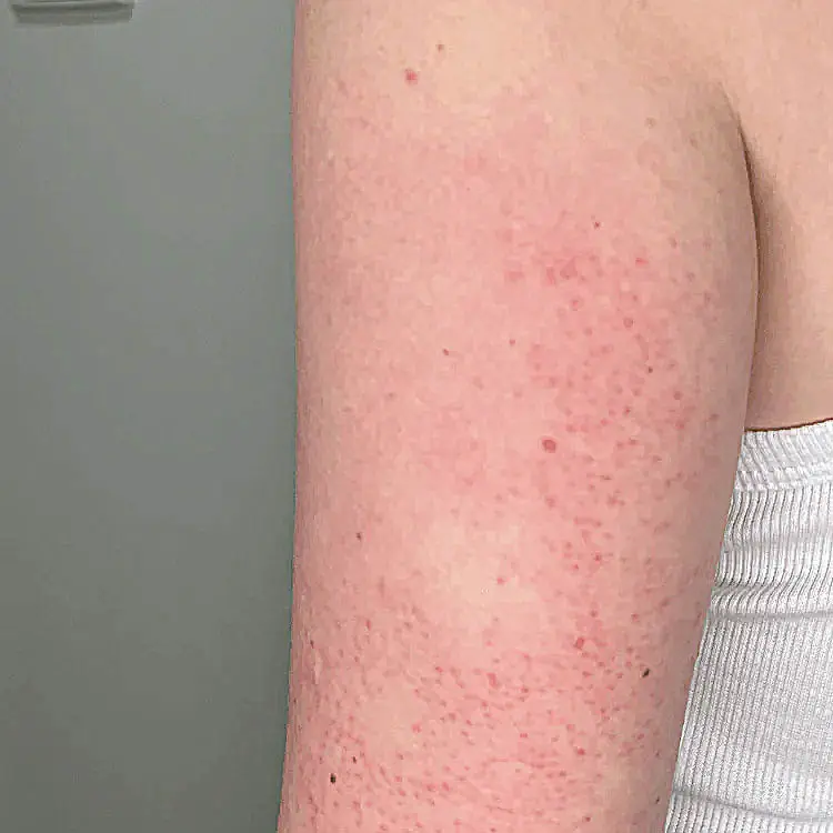 Keratosis Pilaris