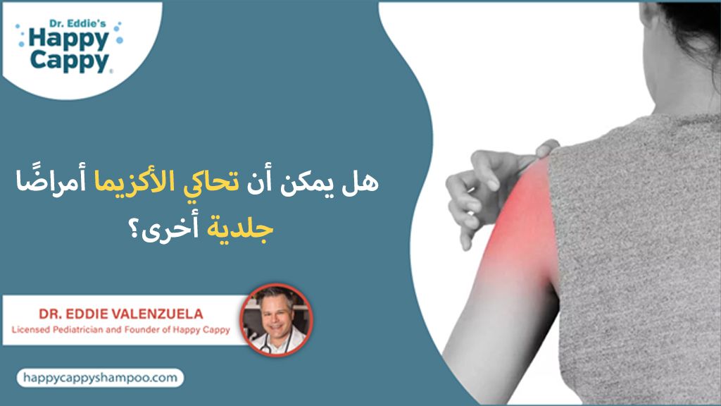 هل يمكن أن تحاكي الأكزيما أمراضًا جلدية أخرى؟