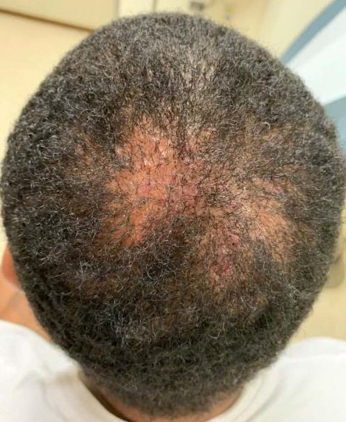 Caso clínico de acné queloideo de la nuca con granos inflamados y pérdida de pelo
