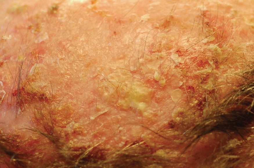 Published clinical photograph showing actinic keratoses and squamous cell carcinomas on a sun-exposed scalp.