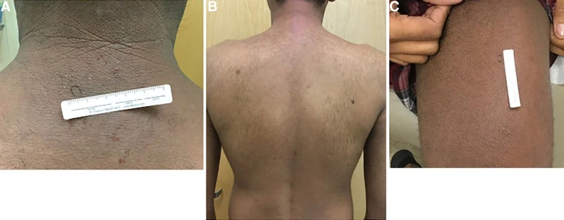 Three clinical views showing widespread atopic dermatitis on the neck, back and arm on deeply pigmented skin