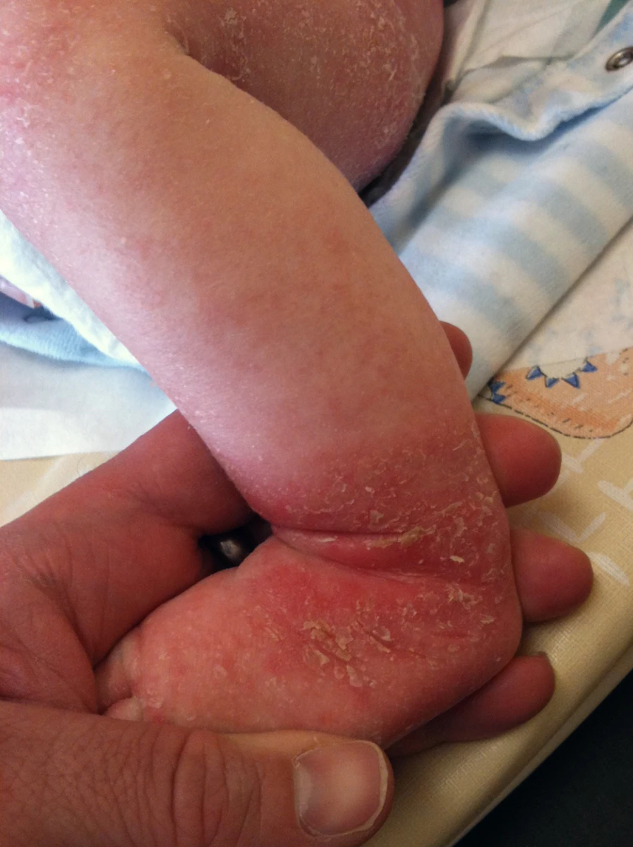 Atopic eczema affecting a child’s ankle and heel