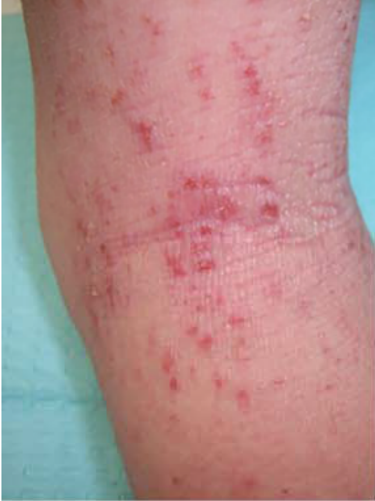 Detail of eczema with linear scratch marks and small breaks in the skin