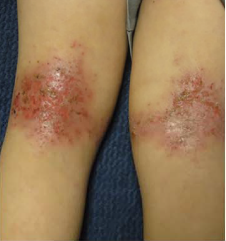 Inflamed eczema around the knees with areas of surface damage