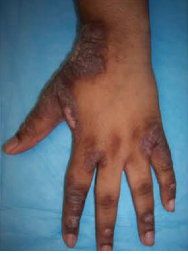 Lichenified eczema on a hand and wrist with darker thickened skin and prominent lines