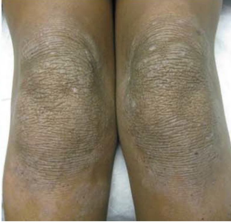 Detail of lichenified knees with thickened skin and a pronounced network of skin lines