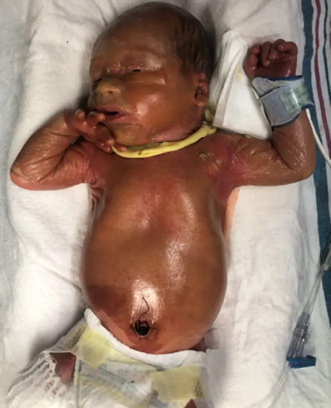 Newborn with a tight, shiny collodion membrane covering the face, trunk and arms.