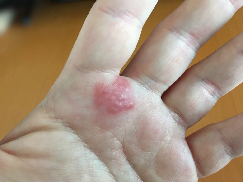 Example of a contact dermatitis patch on the palm beneath the fingers