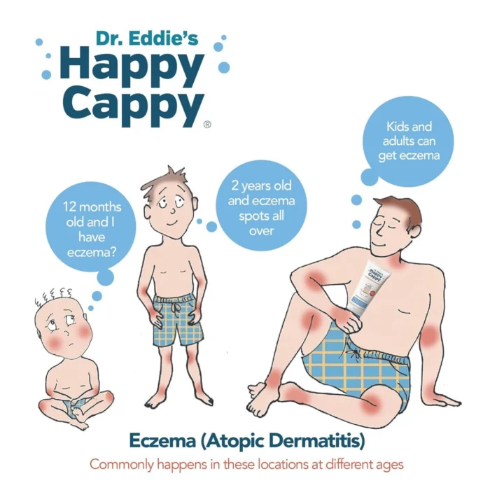 Illustration showing common eczema locations at different ages, alongside Happy Cappy Moisturizing Cream.