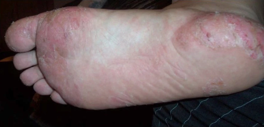 Peeling-stage dyshidrotic eczema affecting the sole