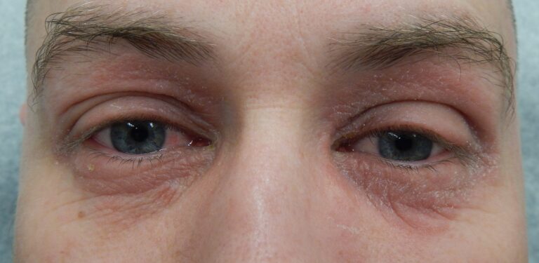 Red and inflamed skin around both eyes in a photograph of eyelid dermatitis.