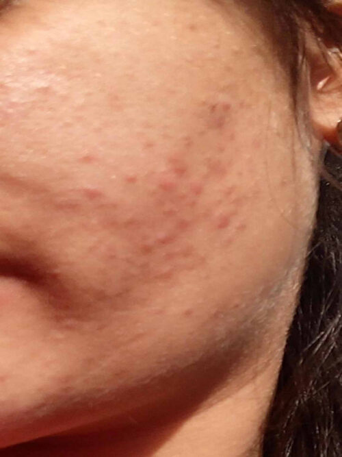 Small red papules on the cheek in a published case of Malassezia folliculitis, with some residual darker marks.