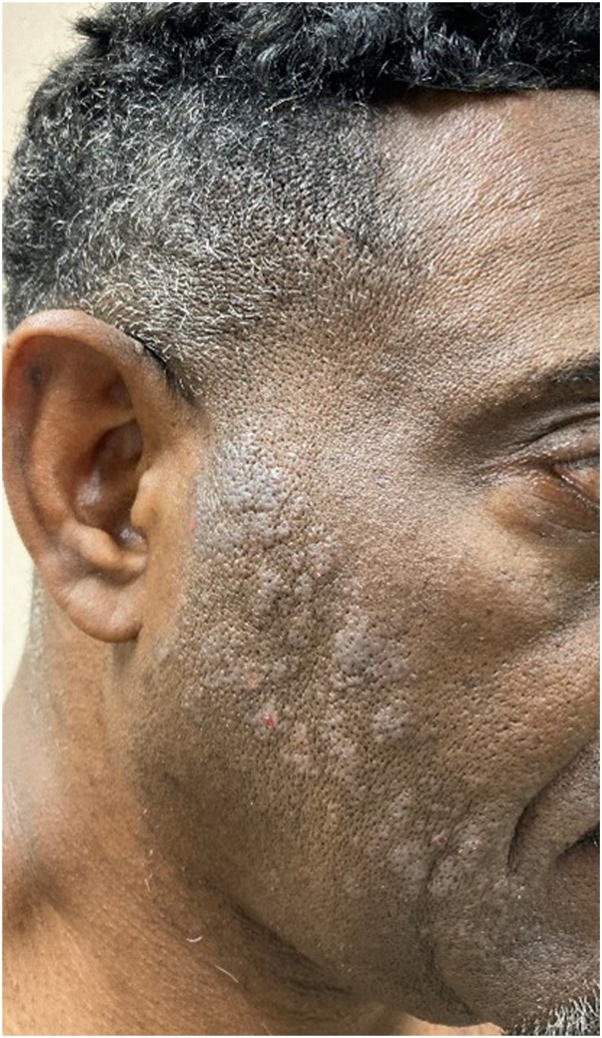 Hair dye allergic contact dermatitis showing small lighter scaly bumps on the cheek near the ear and hairline on darker skin.