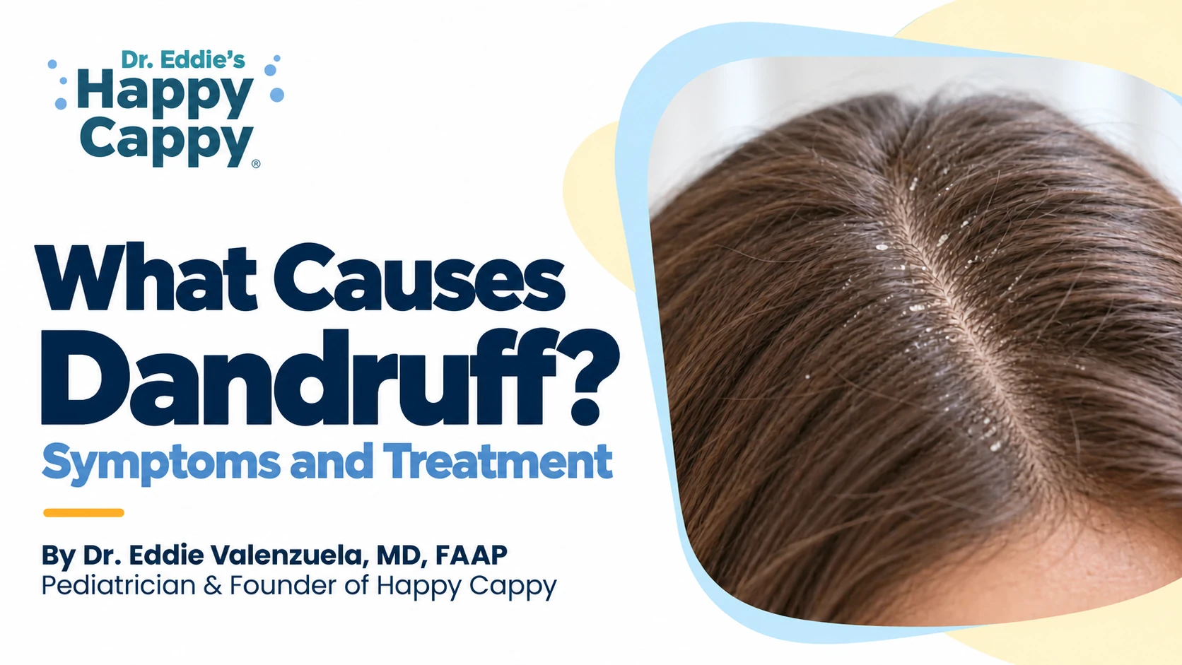 What causes dandruff? Symptoms and treatment, with a close-up of white flakes along a hair part.