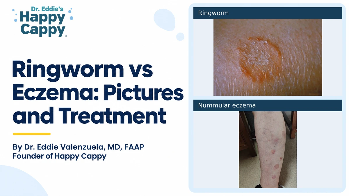 Ringworm vs Eczema: Pictures and Treatment