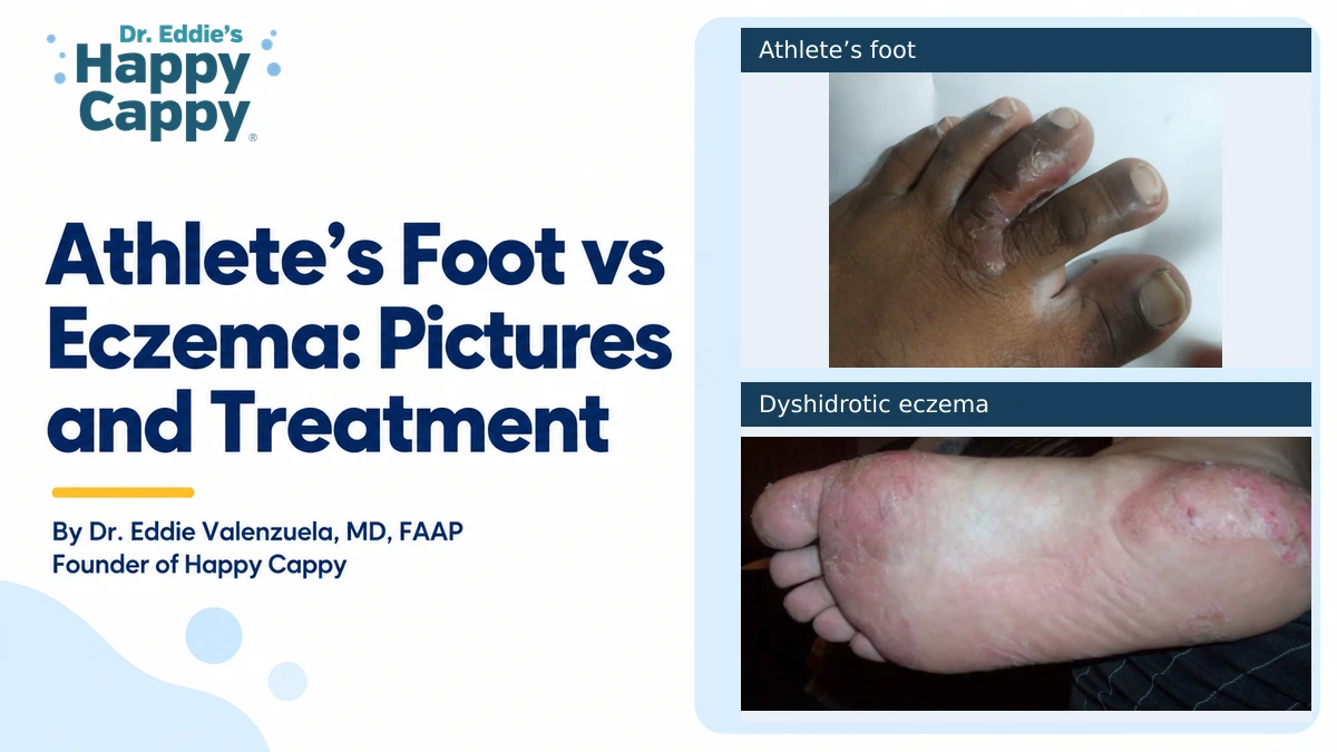 Athlete’s Foot vs Eczema: Pictures and Treatment