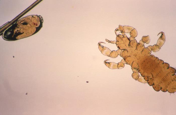 Magnified head-louse egg attached to a hair at left and a young louse at right.