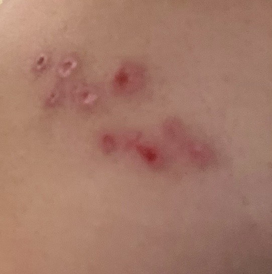 Original clinical photograph of healing shingles lesions on the back.