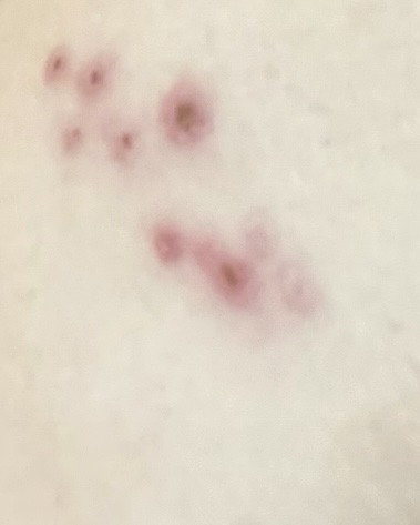 Second original view of healing shingles lesions in the same area of the back.