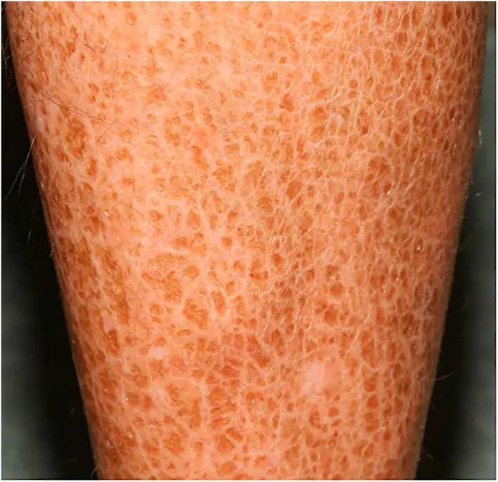 Close-up of dry, fine, polygonal scales on the lower leg in ichthyosis vulgaris.