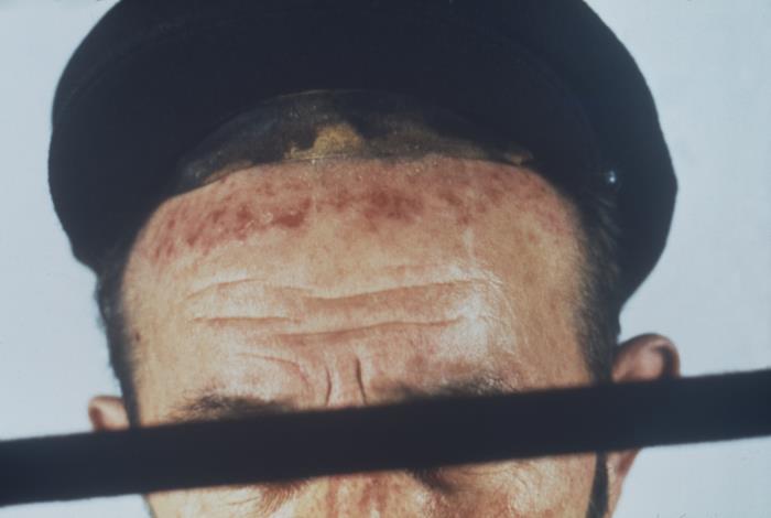 Archival clinical photograph of a forehead rash caused by an irritant in a cap, documented by CDC.