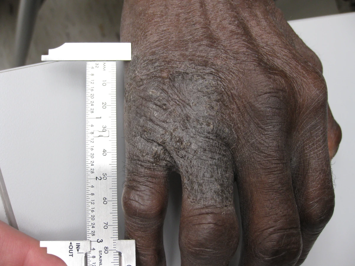 Clinical photograph of lichen simplex chronicus on the back of a hand, showing a thickened, scaly plaque with prominent skin lines on darker skin.