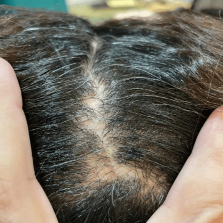 Published clinical photograph of lichen planopilaris showing irregular patches of hair loss around the middle scalp part.