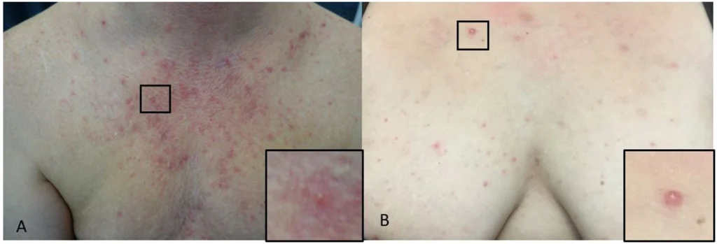 Two published clinical examples of Malassezia folliculitis on the chest, showing small follicular papules and pustules with magnified insets.