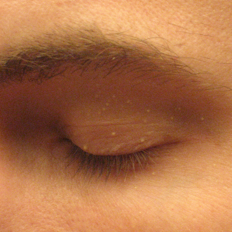 Several small pearly white milia on a closed upper eyelid.