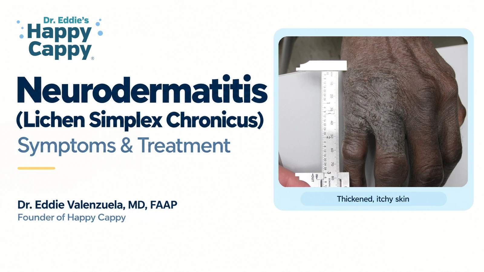Neurodermatitis (Lichen Simplex Chronicus): Symptoms and Treatment
