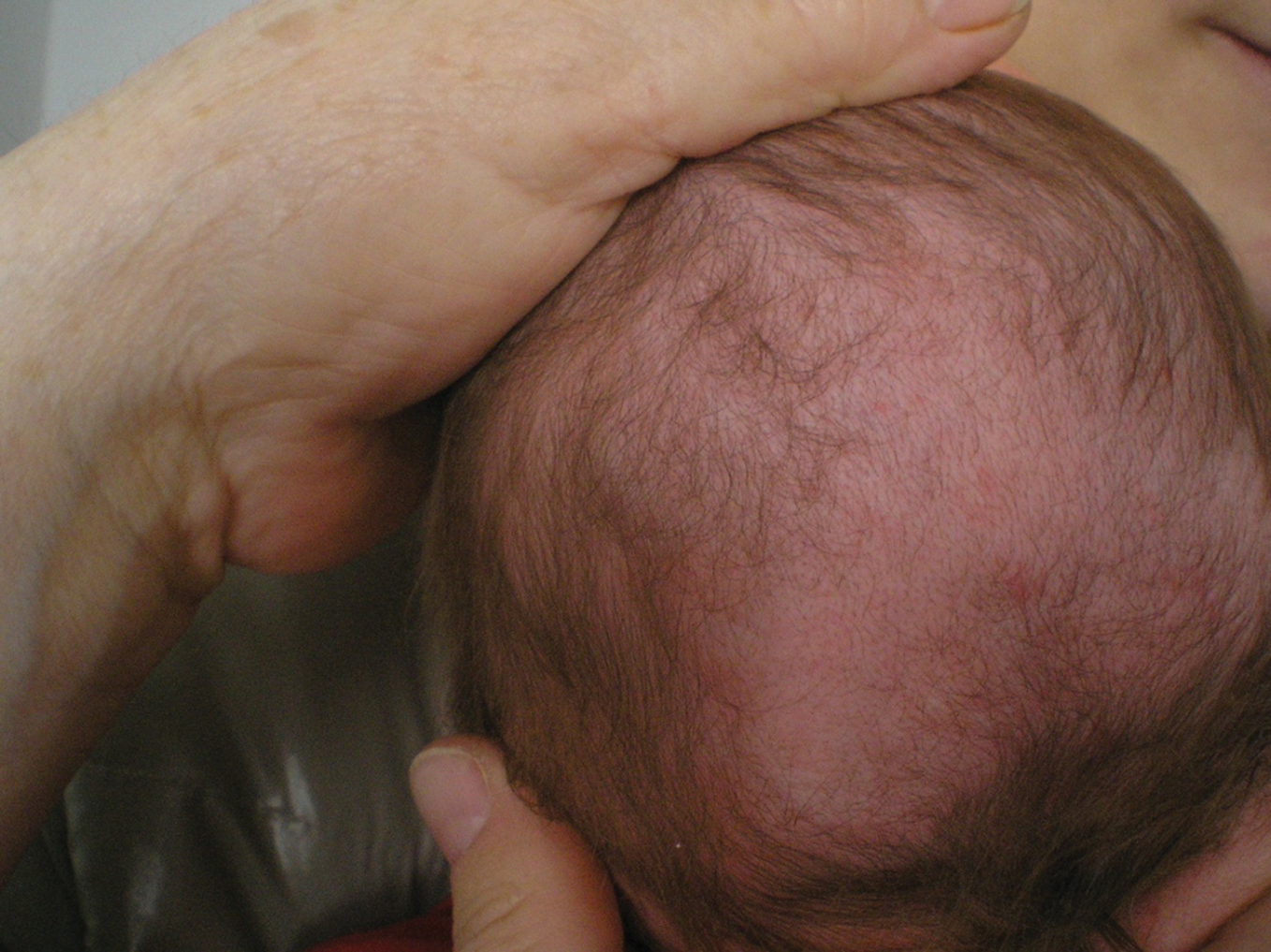 Back of a newborn’s head showing reduced hair density without thick scalp scales.