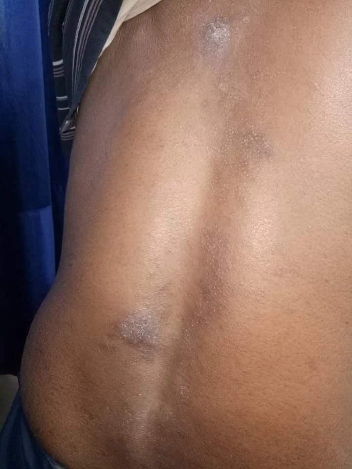 Round scaly plaques of nummular eczema across the back on brown skin