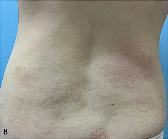 Patch-stage mycosis fungoides with faint pink patches and fine scaling on the back