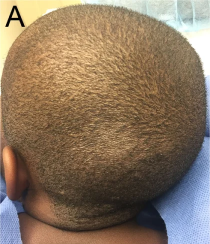 Tinea capitis in a child, showing a patch of hair loss with short, broken hair shafts.