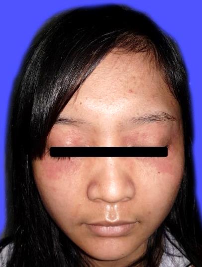 Red patches and small bumps around both eyes in a published case of periorificial dermatitis; the source photograph includes a black privacy bar over the eyes.