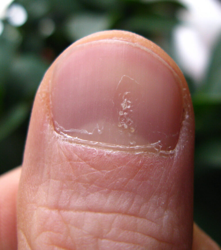Close-up of small pits scattered across a fingernail affected by psoriasis