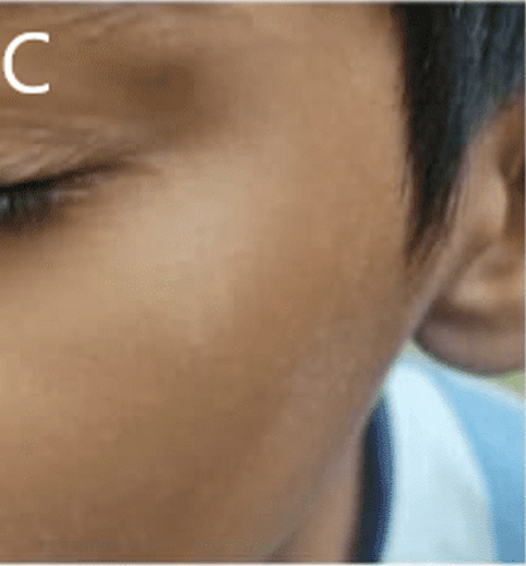 Lighter patch on a ten-year-old child’s cheek as pityriasis alba resolves
