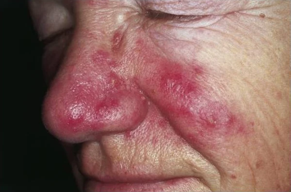 Rosacea with redness, visible vessels and inflamed bumps on the nose and cheek