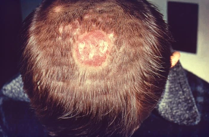 Documented scalp kerion with a circular crusted inflamed patch and localized hair loss