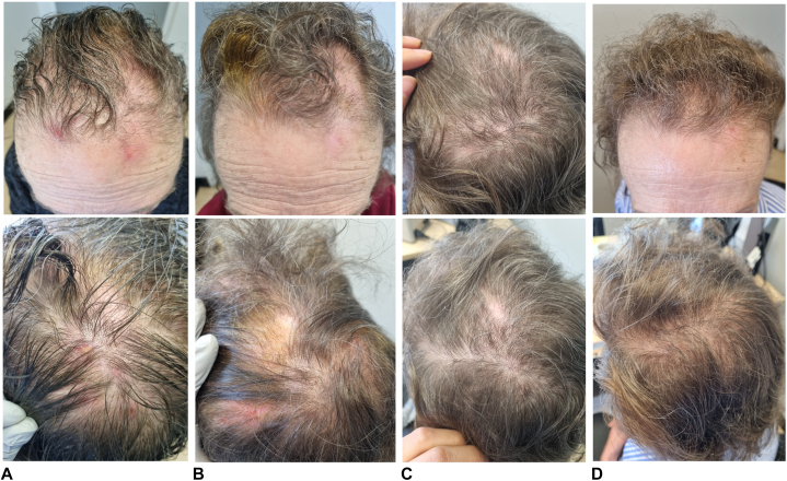 Published sequence of scalp neurodermatitis with scratching and hair pulling, before prescription treatment in column A and at follow-up in columns B through D.