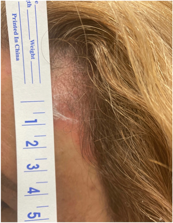 Clinical photograph of a pink scaly psoriasis plaque at the temple beside the hairline.
