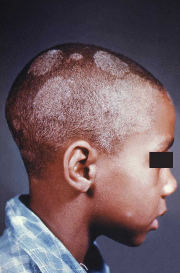 Clinical photograph of scalp ringworm showing patchy hair loss and lighter areas on a child's scalp.