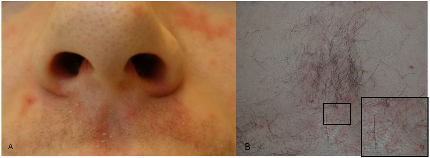 Clinical photographs of seborrheic dermatitis showing redness and scale beside the nose and on the chest.