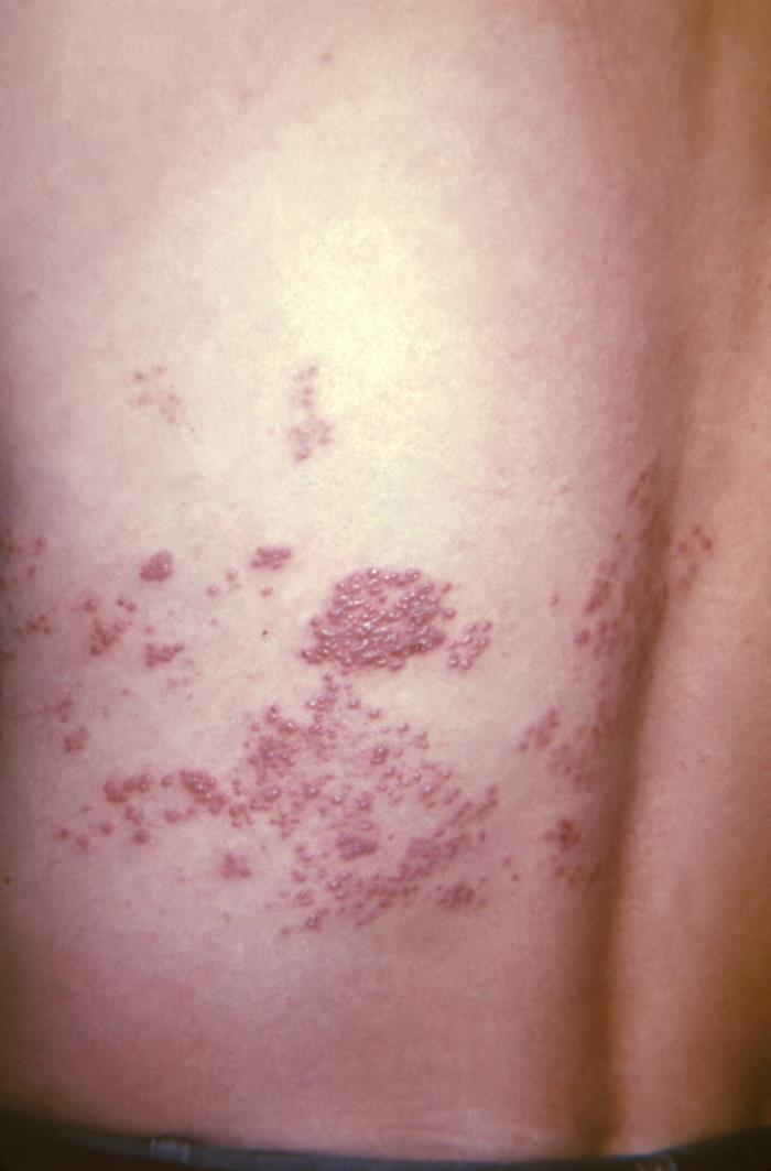 Clinical photograph of grouped shingles lesions on one side of the lower back.
