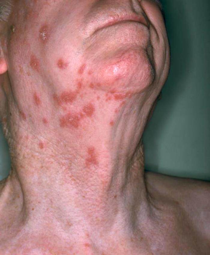 Clinical photograph of shingles lesions on one side of the neck and lower face.