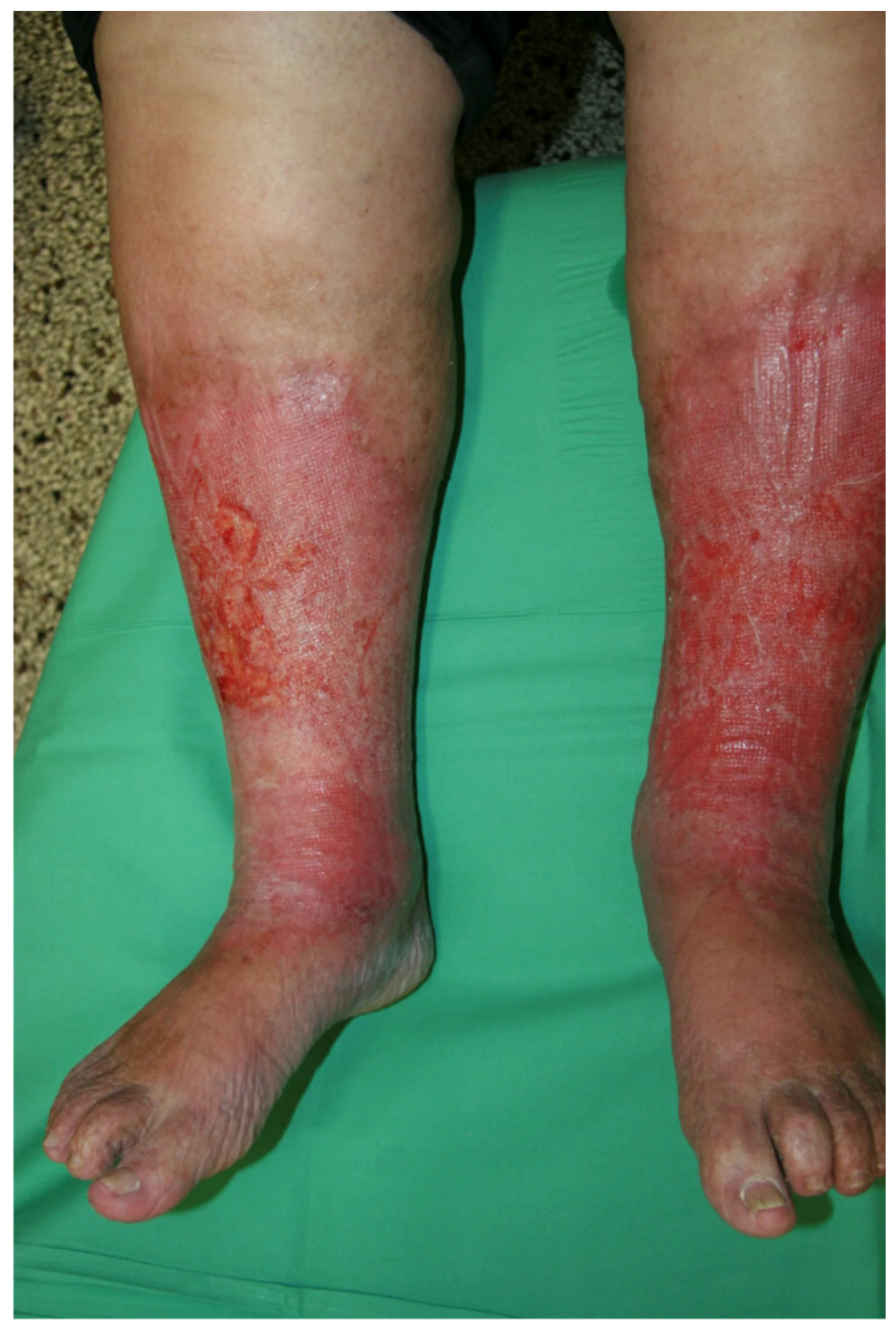 Bilateral lower-leg inflammation, scaling and surface erosions in a published stasis dermatitis case