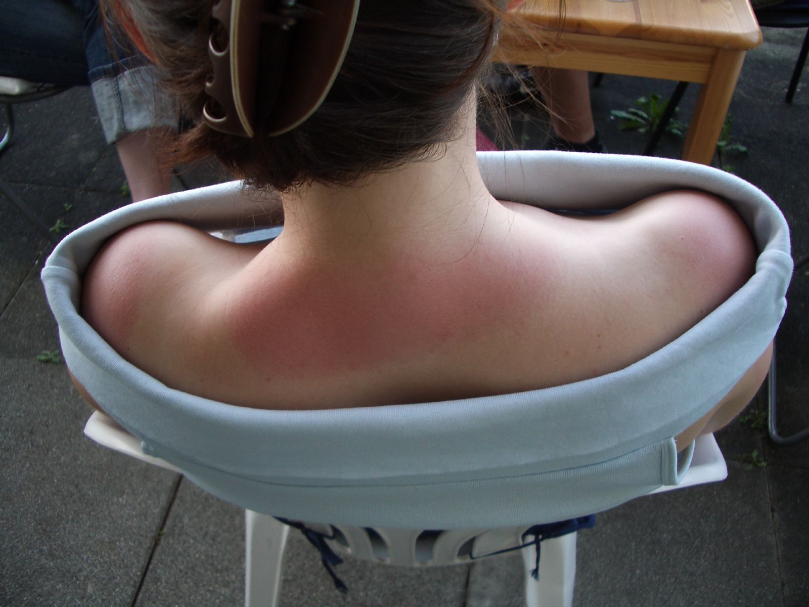 Sunburn causing redness on exposed skin at the nape of the neck and shoulders below the hairline.
