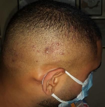 Pequeñas pústulas y granos inflamados junto a la línea del cabello en un caso de foliculitis superficial